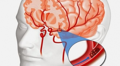 RE-SPECT CVT: Безопасность и эффективность Дабигатрана относительно Варфарина с подобранной дозировкой у пациентов с церебральным венозным тромбозом